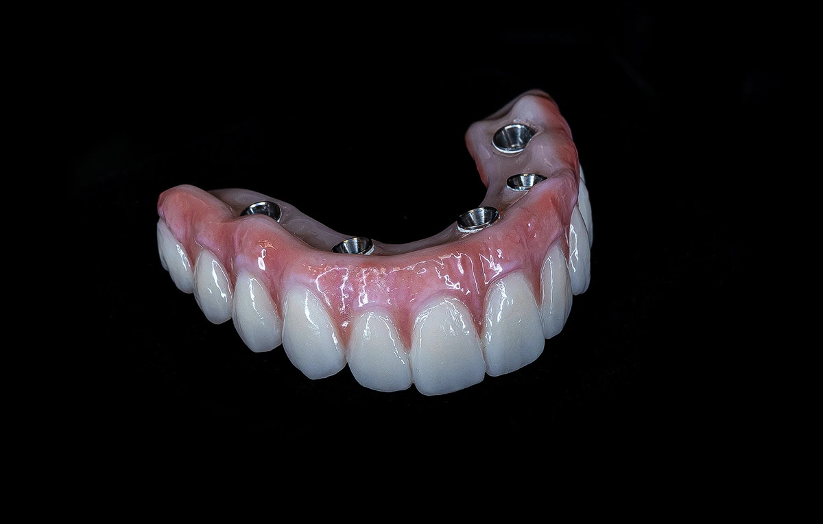 Implantet dentare