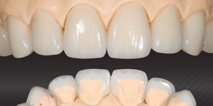 Veneers